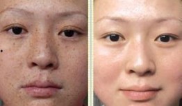 徒手祛斑爆料视频大全,视频大全带你轻松告别斑点困扰