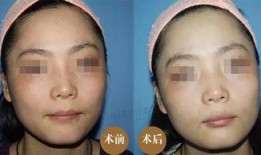 徒手祛斑爆料视频大全,视频大全带你轻松告别斑点困扰